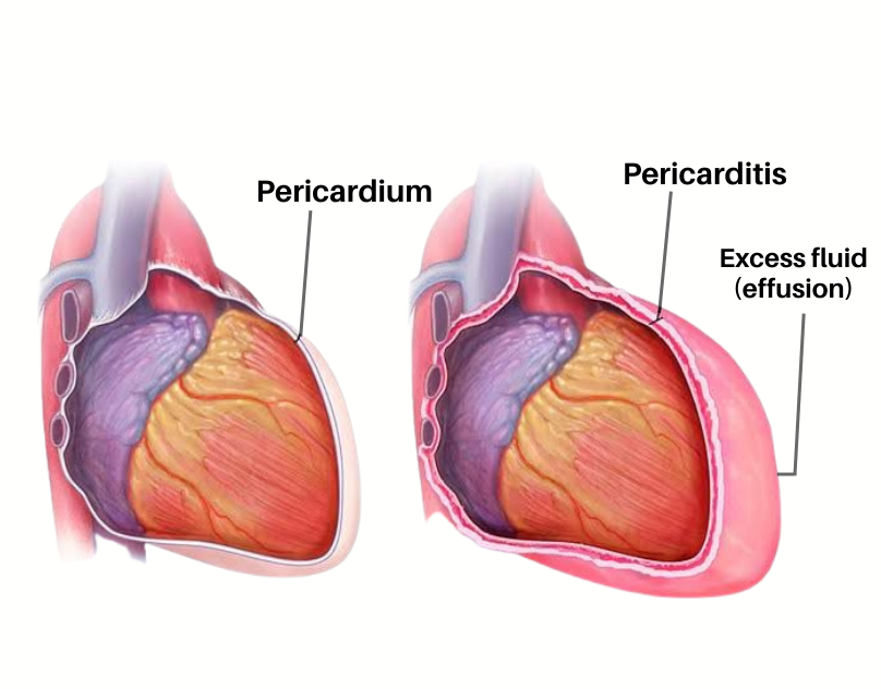 Get the best Pericardial Diseases Treatment from our Doctor in Bangalore