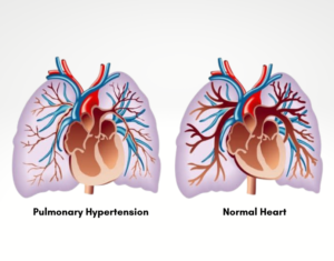 Best Pulmonary Hypertension treatment in Bangalore